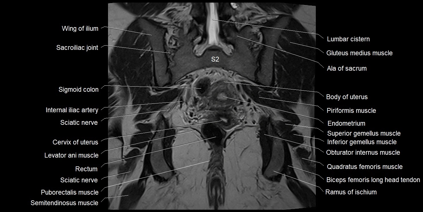 female pelvis coronal cross sectional anatomy image 25.webp
